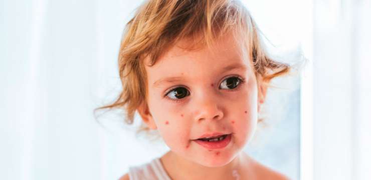 chickenpox in kids, kids with chickenpox